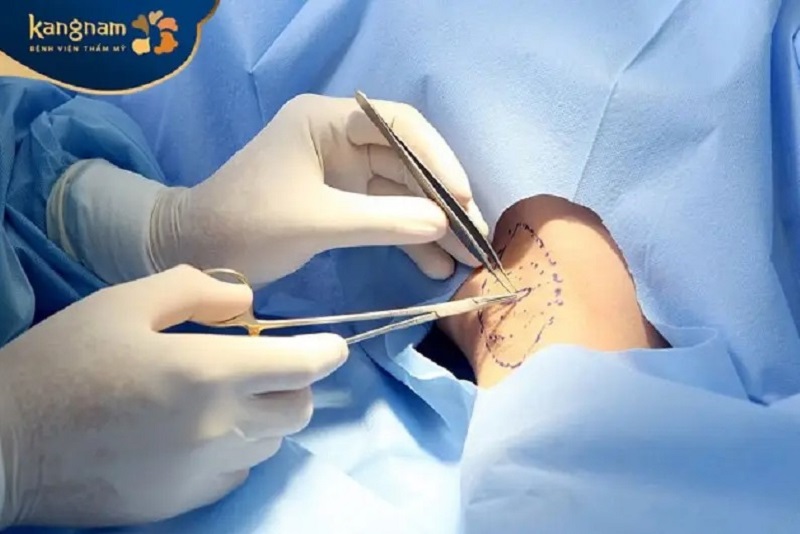 Cắt tuyến mồ hôi nách giúp ngăn ngừa hôi nách hiệu quả