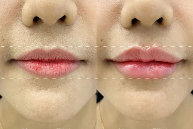 Tiêm filler tạo môi tim