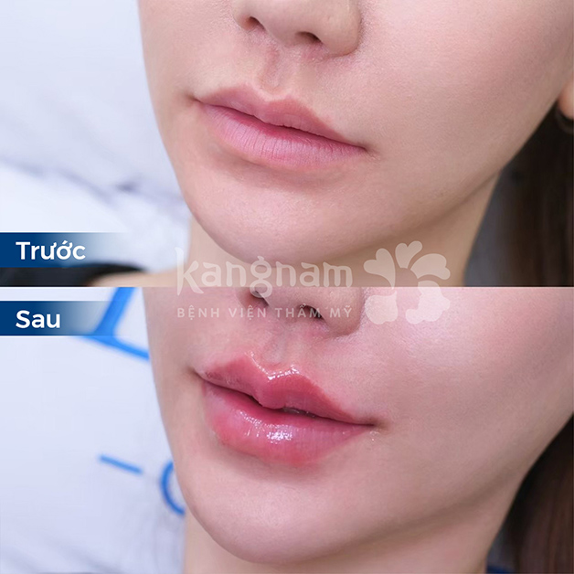 Tiêm filler