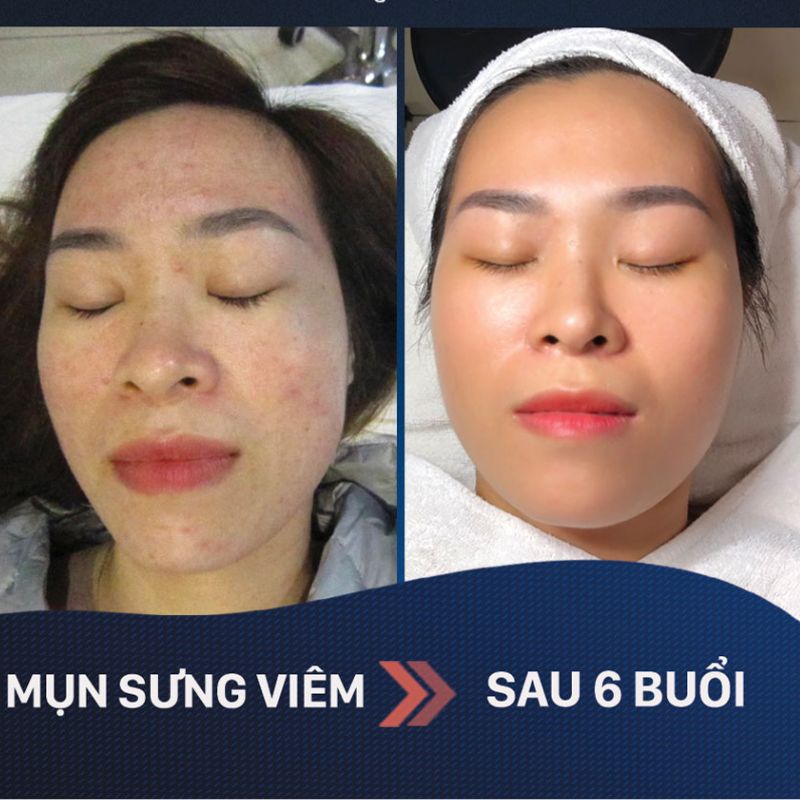 Hết mụn đỏ, xóa sổ thâm lâu năm