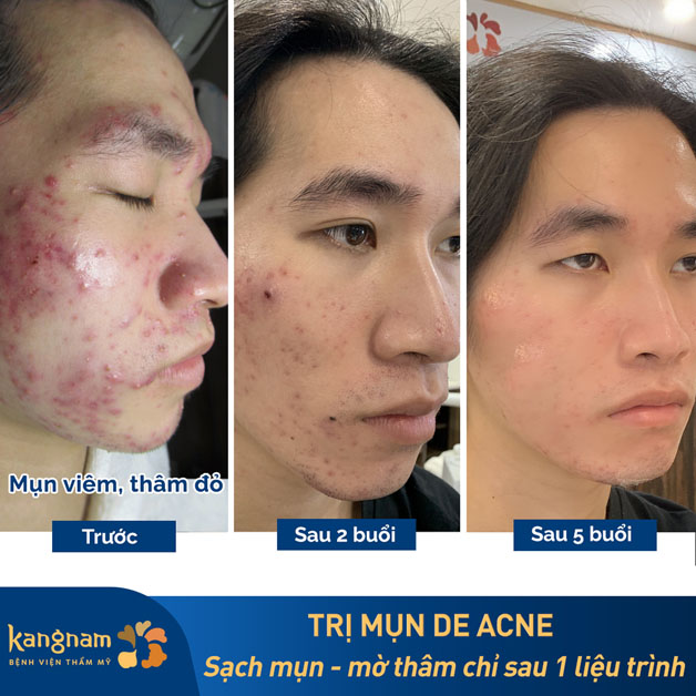 Khách hàng trị mụn và trị thâm sau 5 buổi