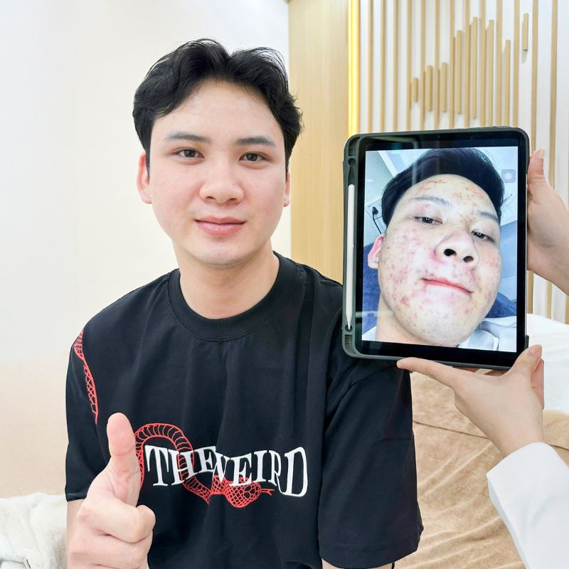 So sánh làn da trước và sau khi điều trị laser