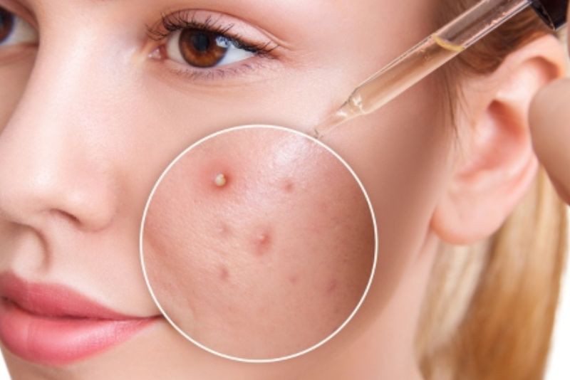 Sản phẩm chứa Retinoids giúp tái tạo da, làm mờ thâm đỏ