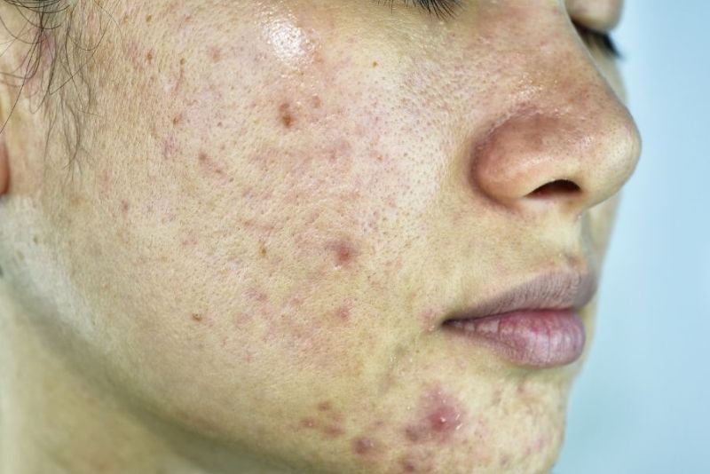 Tình trạng mụn thâm đỏ