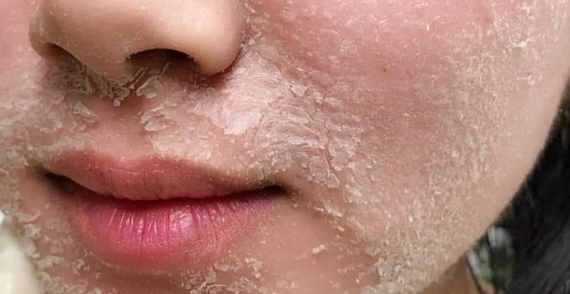 Peel Da làm bong lớp da chết