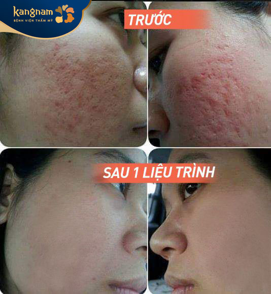 Da căng mịn, không còn vết thâm hay sẹo rỗ