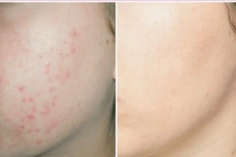 Phương pháp điều trị ảnh hưởng trực tiếp đến kết quả