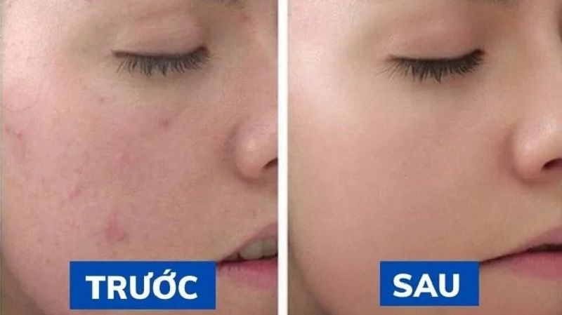 Peel da có thể loại bỏ tế bào chết