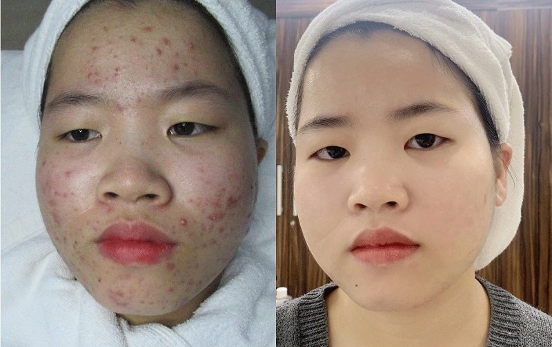 Thực hiện trị thâm mụn chuyên sâu tại cơ sở thẩm mỹ uy tín
