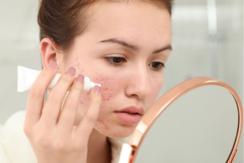 Các sản phẩm kem đặc trị thâm thường chứa thành phần như Niacinamide, Vitamin C, AHA/BHA