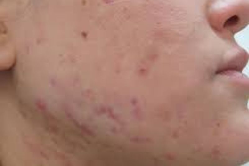 Thâm mụn lâu năm, sậm màu