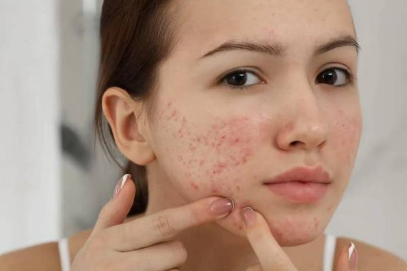 Da dầu thường dễ bị mụn và thâm lâu lành