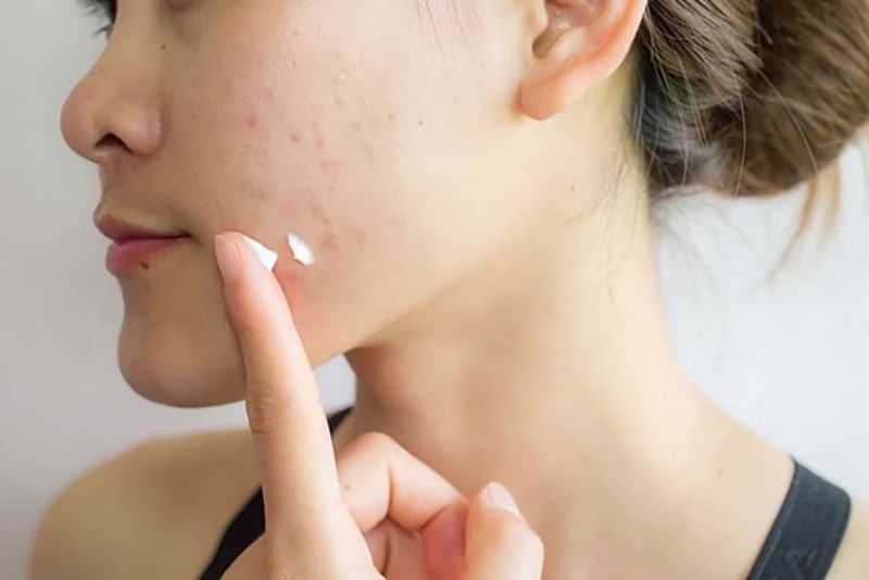 Sử dụng các hoạt chất trị thâm mụn như vitamin C, niacinamide, retinol, AHA/BHA hoặc azelaic acid