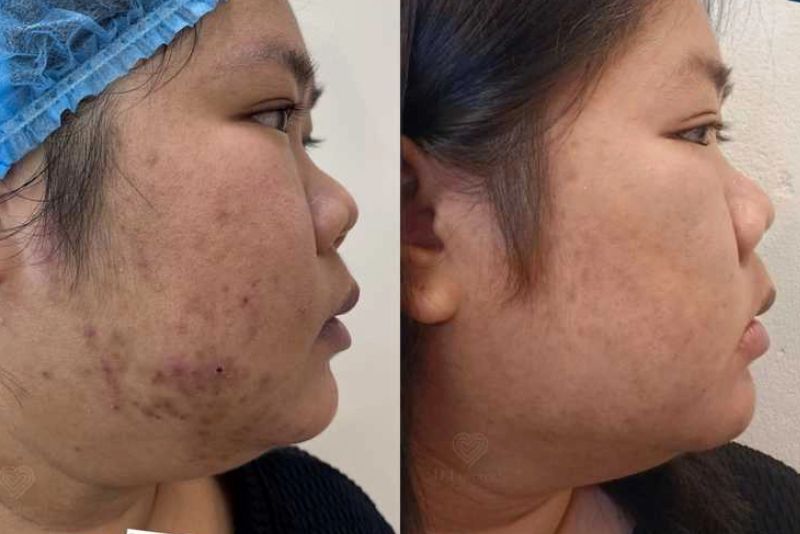 Mờ thâm rõ sau lần điều trị đầu tiên tại Kangnam