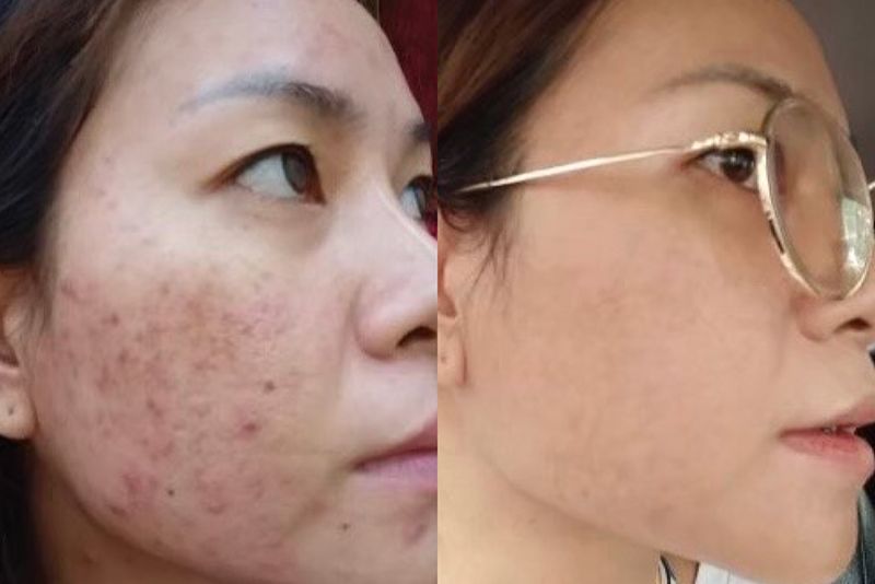 Laser tác động trực tiếp vào vùng thâm, giúp phá vỡ sắc tố melanin tích tụ dưới da