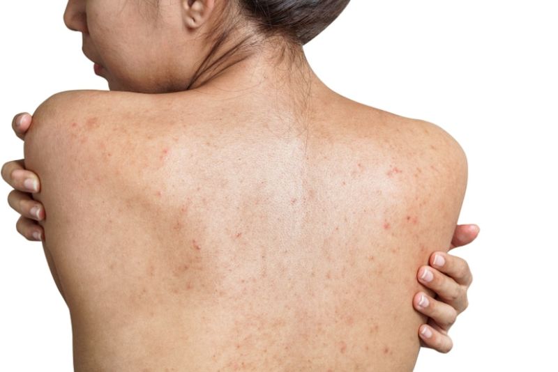 Thâm mụn lưng hình thành do hậu quả của viêm da sau mụn
