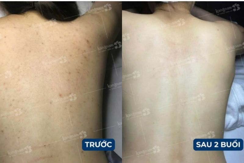Khách hàng đạt kết quả tốt sau khi trị mụn thâm ở lưng tại Kangnam