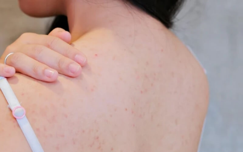 Tránh nặn mụn lưng có thể tăng nguy cơ nhiễm trùng