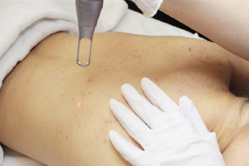 Thực hiện laser trị thâm mụn lưng để để giúp vùng da sáng mịn