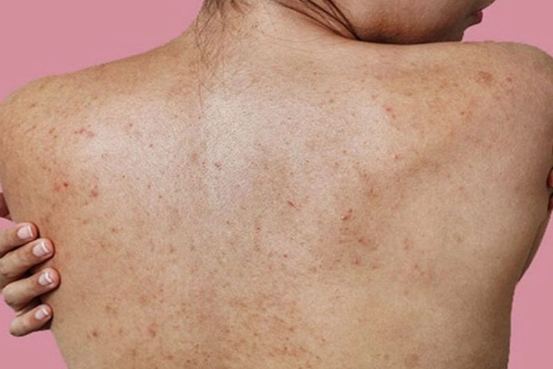 Tình trạng thâm mụn vùng lưng