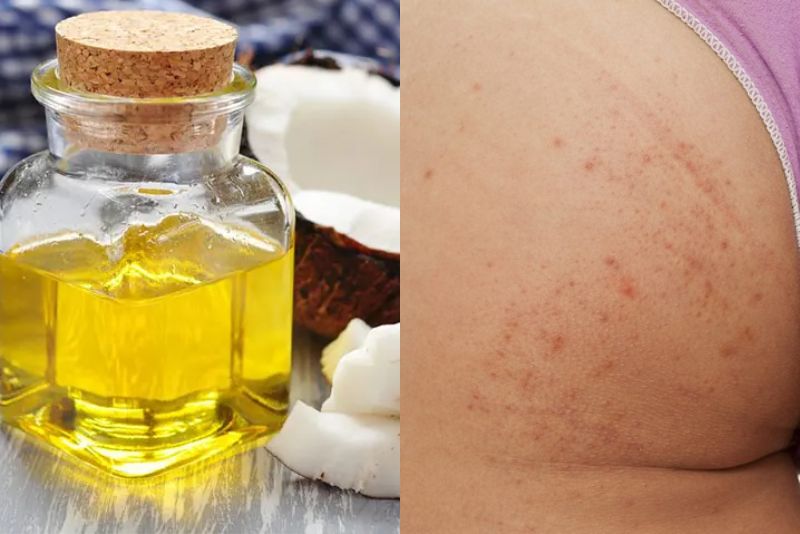 Dầu dừa có khả năng kháng khuẩn, chống viêm