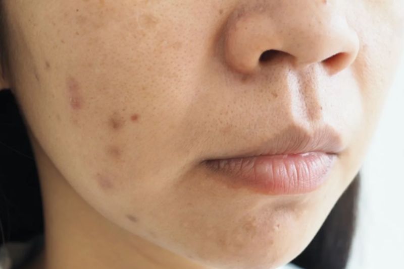 Vết thâm lâu năm cần áp dụng công nghệ hiện đại
