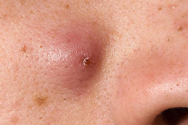Mụn nhọt để lại vết thâm lâu và khó điều trị