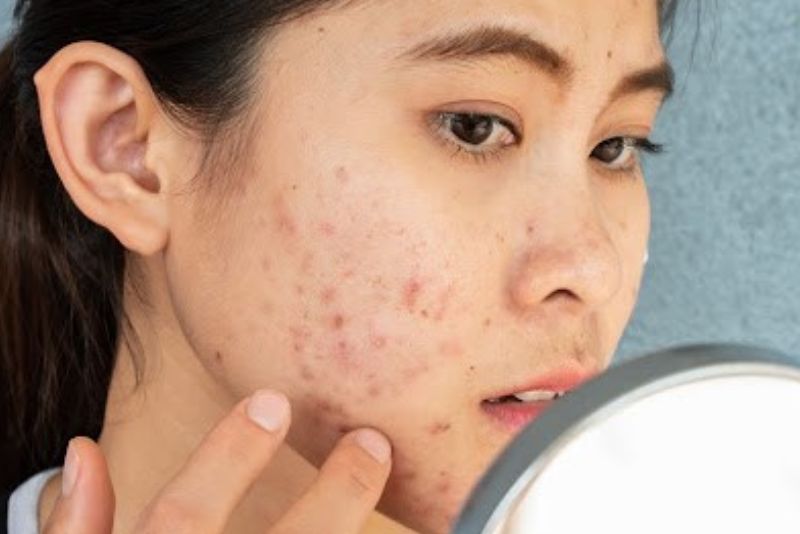 Có nhiều phương pháp giúp trị thâm trên mặt