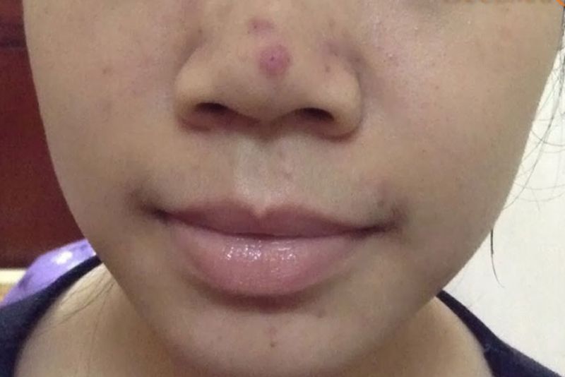 Tình trạng thâm mụn gây mất thẩm mỹ