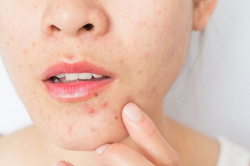 Thâm mụn quanh miệng ảnh hưởng đến thẩm mỹ