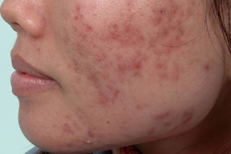 Da bị tổn thương nặng sau mụn