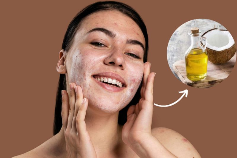 Dầu dừa chứa nhiều axit béo, vitamin E và chất chống oxy hóa