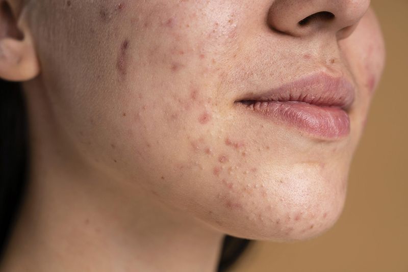 Tình trạng thâm sau mụn trứng cá