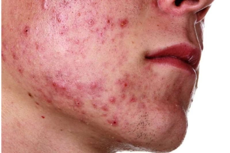 Vết thâm mụn viêm do mụn nặng