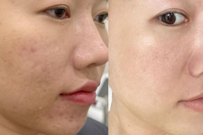 Điều trị thâm mụn tại thẩm mỹ viện có kết quả nhanh, an toàn