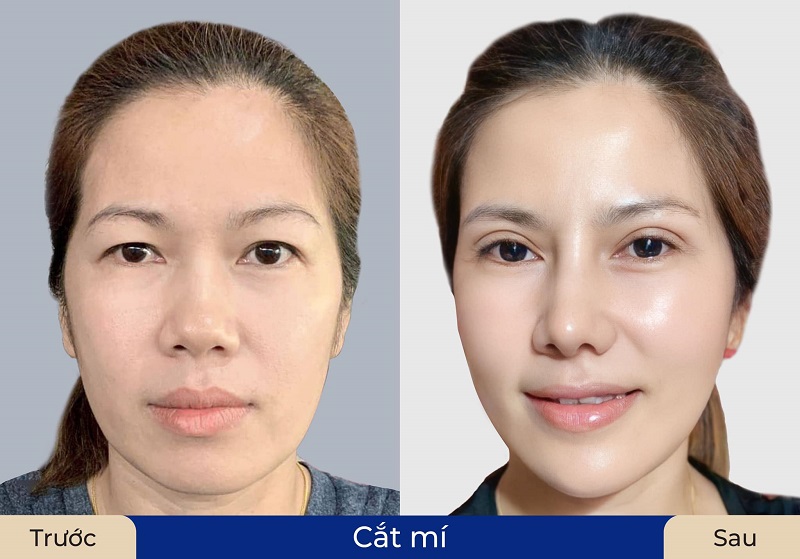 Cắt mí giúp tạo nếp mí đều, tự nhiên và cân đối