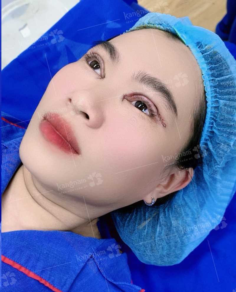 Cắt mí tại địa chỉ thẩm mỹ uy tín sẽ đảm bảo an toàn và tránh những biến chứng xảy ra