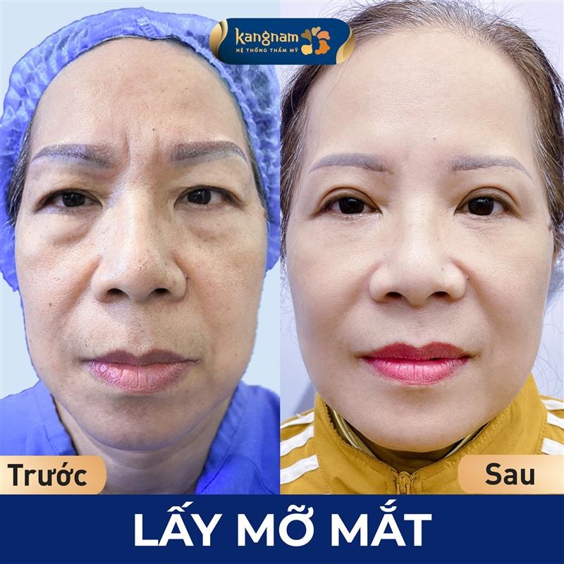 Lấy bọng mỡ giúp khách hàng sở hữu đôi mắt tươi trẻ hơn
