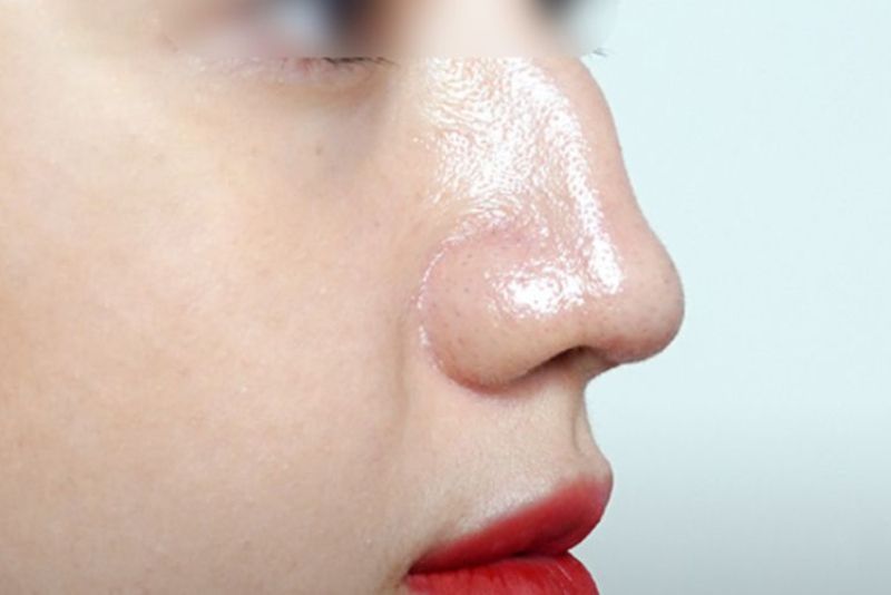 Mũi gãy ở phần sống mũi bị lệch, cong hoặc có điểm gấp khúc rõ ràng