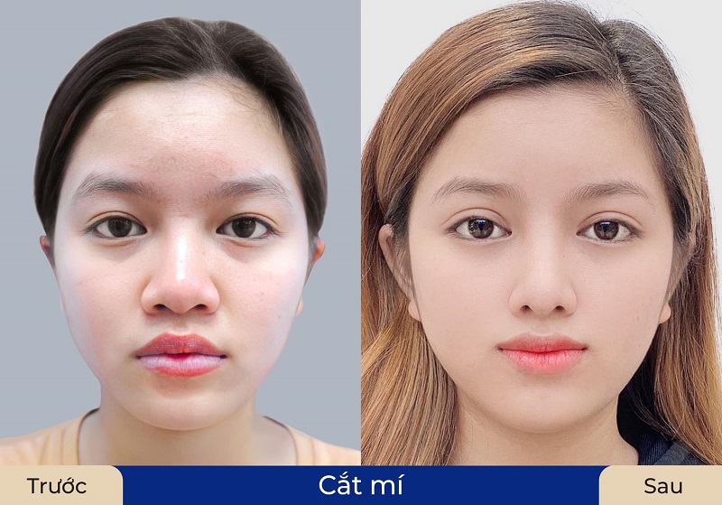 Cắt mí giúp giảm bọng mắt và quầng thâm hiệu quả cao