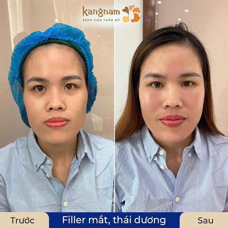 Tiêm filler sẽ giúp giảm thiểu tình trạng mắt thâm quầng