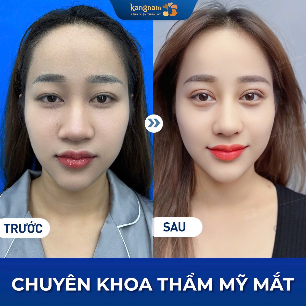 Cắt mí mắt là giải pháp giúp tạo đôi mắt cân đối, to tròn
