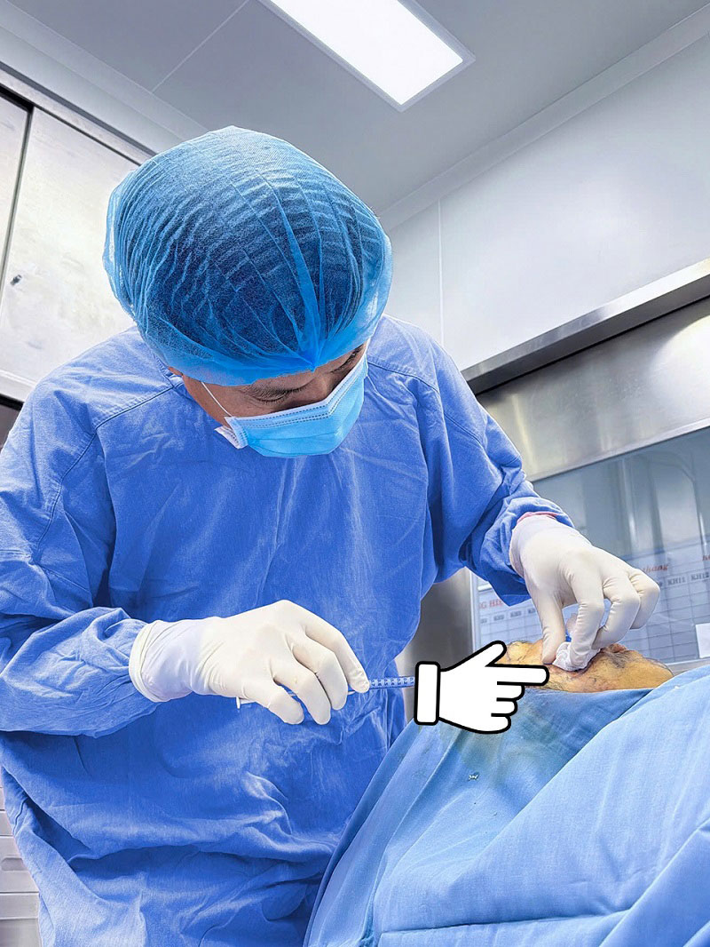 Mỡ tự thân được cấy vào vùng hốc mắt đúng quy trình