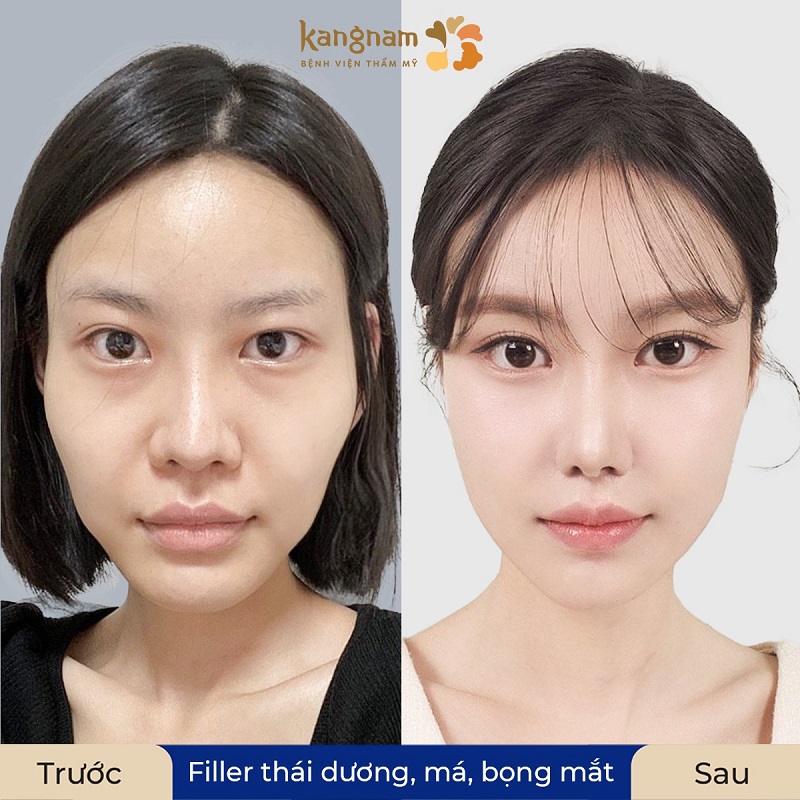 Tiêm filler tạo bọng mắt được nhiều chị em lựa chọn