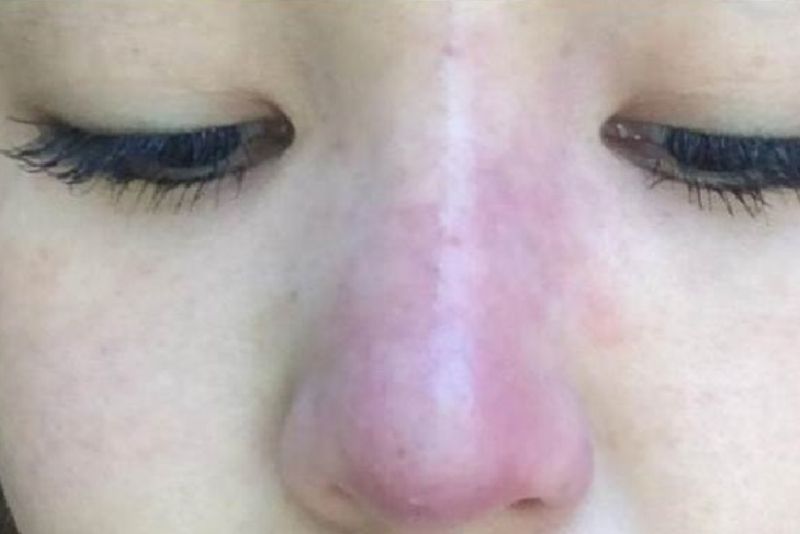 Biểu hiện nhiễm trùng sau nâng mũi