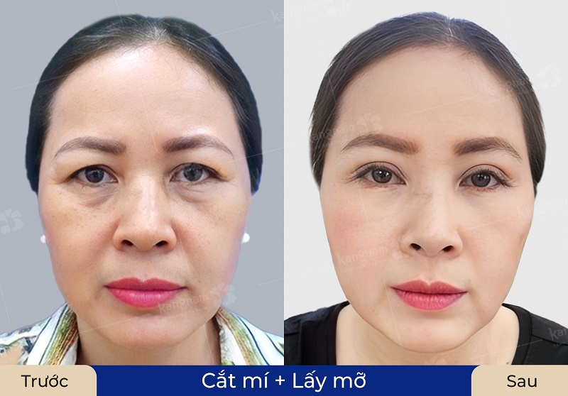 Cắt bọng mỡ mắt giúp đôi mắt tươi trẻ, rạng ngời hơn