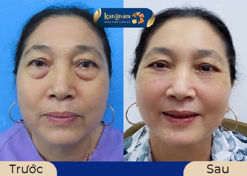 Khách hàng sau lấy mỡ bọng mắt gương mặt tươi trẻ hơn