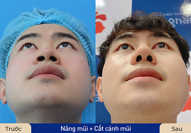 Mũi thon gọn và hài hòa sau khi cắt cánh mũi và nâng mũi