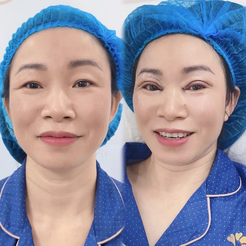 Cắt da thừa mí mắt giúp loại bỏ da chùng nhão