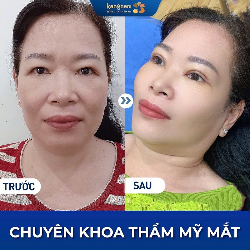 Mí mắt của khách hàng cân đối, rõ nét hơn sau khi loại bỏ da dư